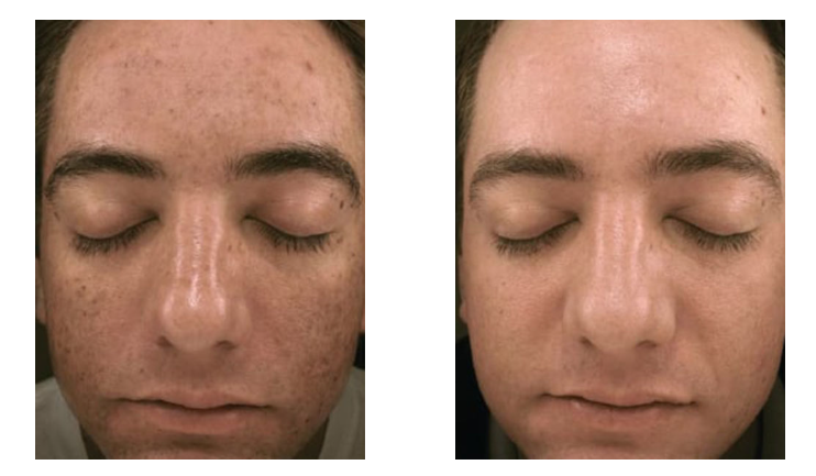 microneedling